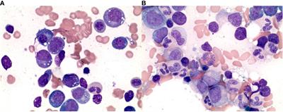 Successful treatment with fludarabine and cyclophosphamide in a VEXAS syndrome patient with associated myelodysplastic syndrome: a case report and systematic review